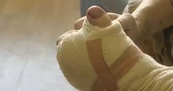 Video: Mans Thumb Replaced with his Toe