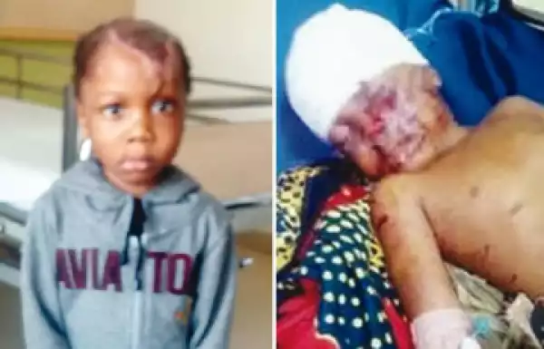 Boy Attacked By Dogs Returns From India
