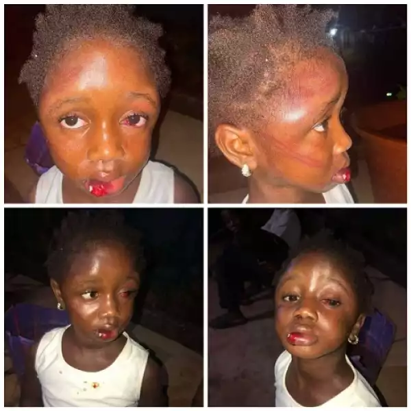 Starving 5-year-old Girl Mercilessly Beaten by Her Aunt For Taking Food From Pot to Eat (Photo)